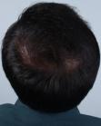 After Hair Transplant &nbsp;Midscalp